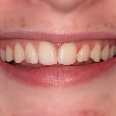 Dental Cosmetic Bonding before